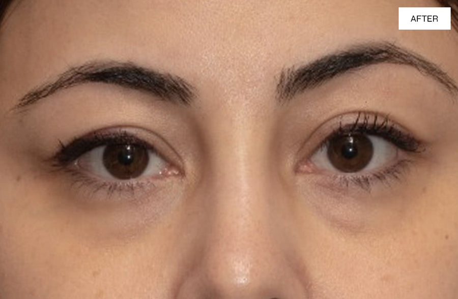 Perfect 360 Eye Illuminate After