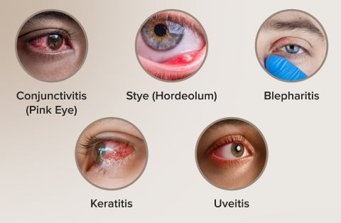 What Are Eye Infections?