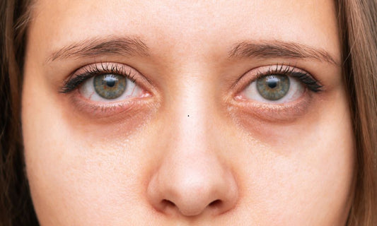 Dark Circles