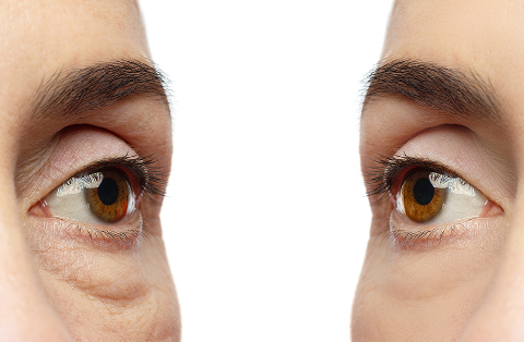 Differences between Dark Circles vs Eye Bags