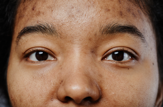 Does Vitamin C Help With Hyperpigmentation?
