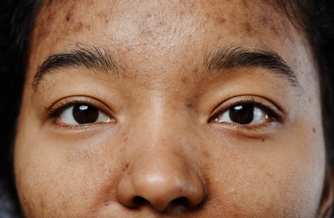 Does Vitamin C Help With Hyperpigmentation?