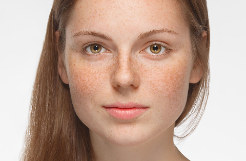 How to treat hyperpigmentation