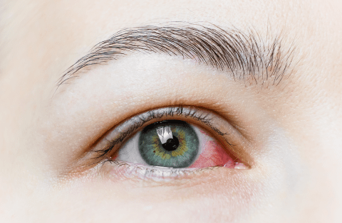 What are Bloodshot Eyes
