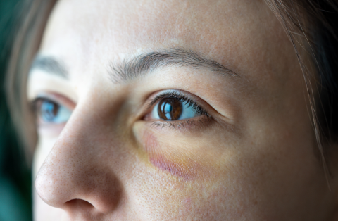What are Sunken Eyes: Causes, Symptoms and Prevention