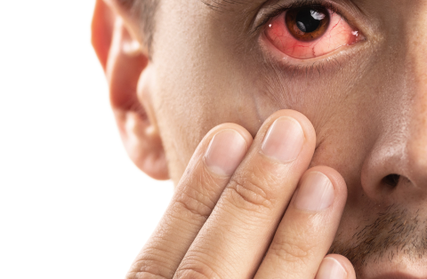 Conjunctivitis: What Is Pink Eye?