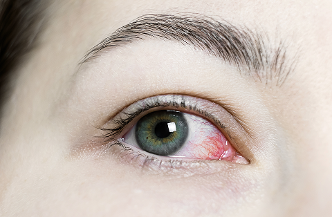 bloodshot eyes causes