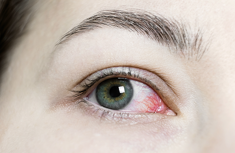 Red and Bloodshot Eyes: What Causes Eyes to be Red