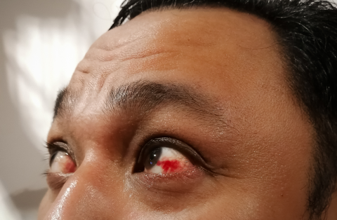 Can Your Eyes Get Sunburnt? Symptoms, Causes and More