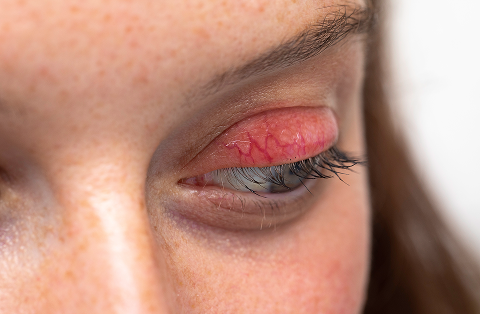 red itchy eyelids