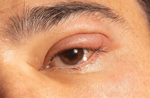 Remedies for swollen eyes: Complete Guide