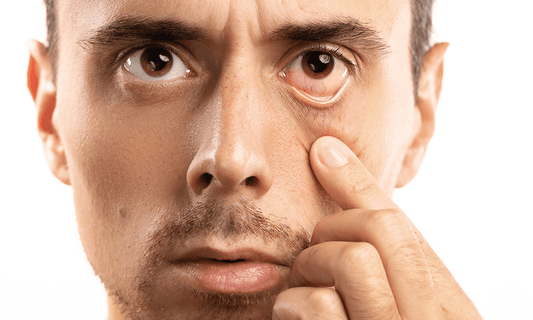 how to cure pink eyes