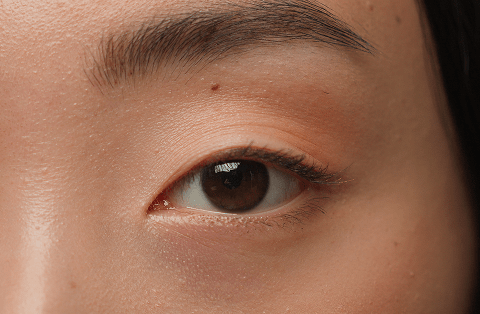 how to remove eye bags permanently