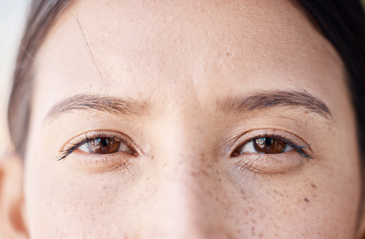 What Causes Bags Under Eyes?