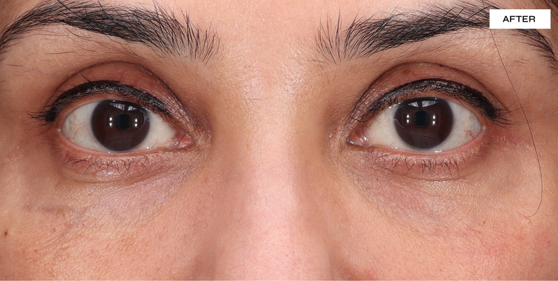 before after dark circles