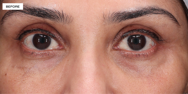 Dark circle before and after results