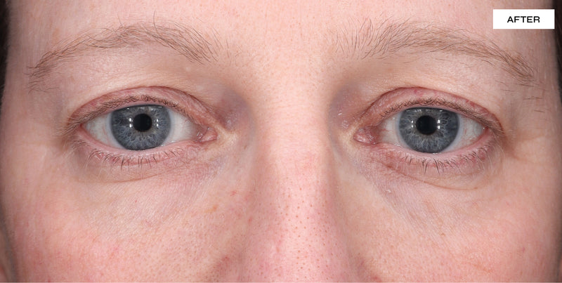 After using Dr. Sabrina Eye Regenerate LED Mask