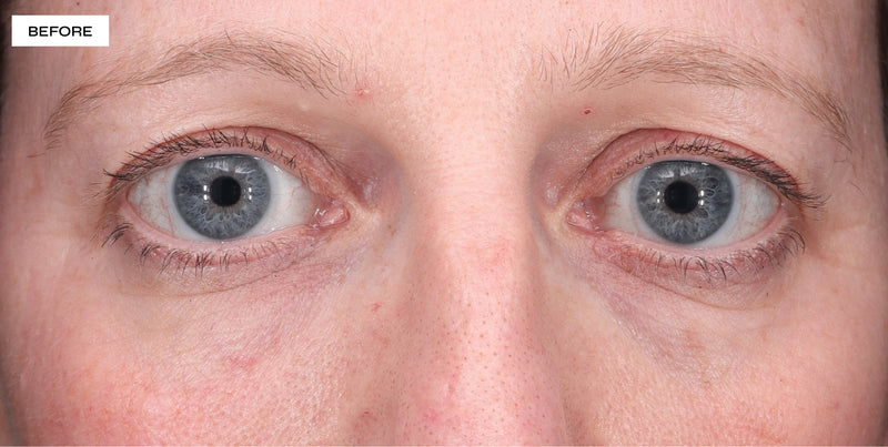 dark circles under eyes before and after