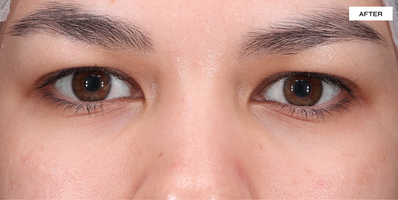 before and after dark circles