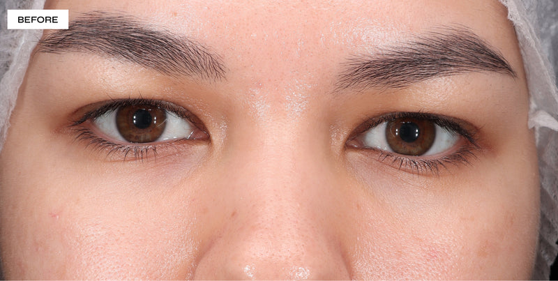 dark under eye circles before and after