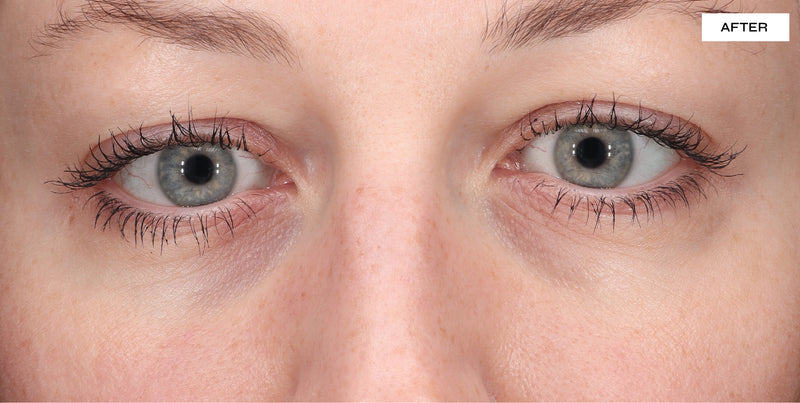 before and after bags under eyes