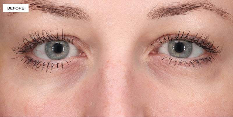 under eye bags before and after​