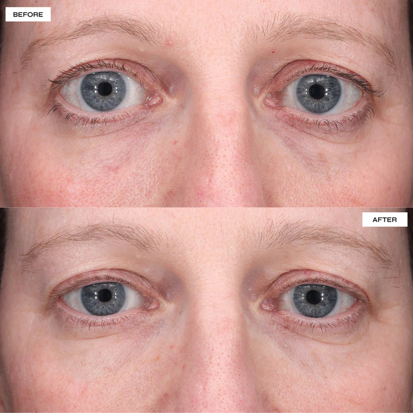 DR SABRINA™ BRIGHT EYE HYDROCOLLOID PATCHES - REFILL PACK